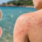 Sea Lice Rash Symptoms, Treatment and Prevention